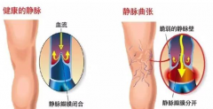 静脉曲张疾病症状以及危害有哪些？