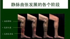 昆明三一一医院医生介绍静脉曲张症状有哪些？