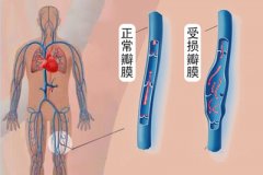 静脉曲张的治疗费用要多少