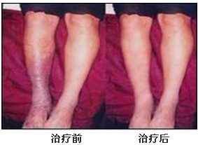 特色疗法治疗“老烂腿”