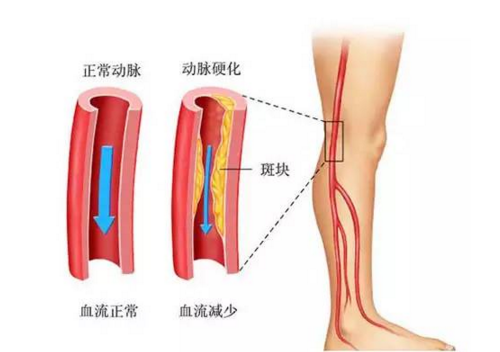 动脉硬化治疗费用是多少