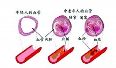 动脉硬化选对疗法可降低治疗费用