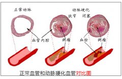 动脉硬化的自我检查方法