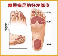 糖尿病足的护理措施