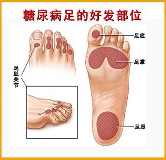 糖尿病足的护理措施