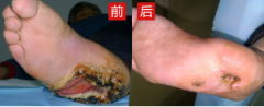 了解糖尿病足症状可科学自检