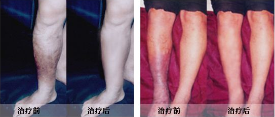 血栓性静脉炎患者需知