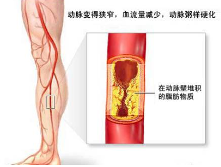 动脉硬化如何选择治疗方法比较好？