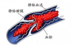 导致静脉血栓的原因是什么呢?