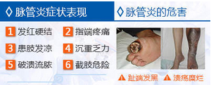 当心脉管炎早期症状！