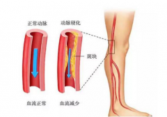 动脉硬化如何治疗比较有效？