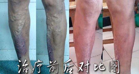 静脉炎的治疗效果