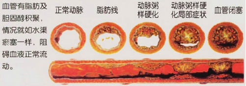 出现动脉硬化会给我们带来什么危害