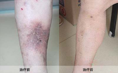 静脉炎的治疗方法有哪些