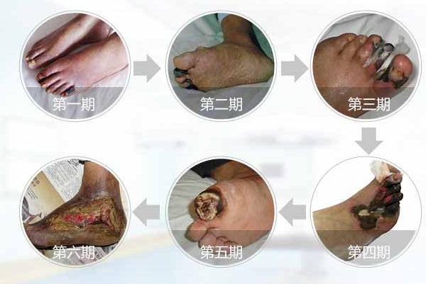 动脉硬化闭塞症怎么治