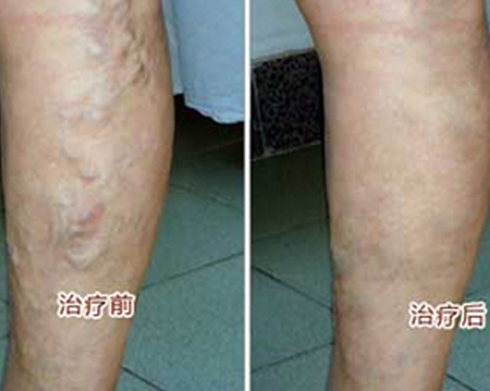 专家解析：静脉炎的危害有哪些