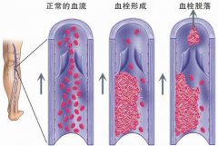 血管堵塞哪种方法治疗的效果好