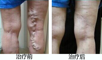 小腿肚子痛是什么原因
