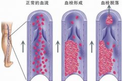 深静脉血栓的危险因素