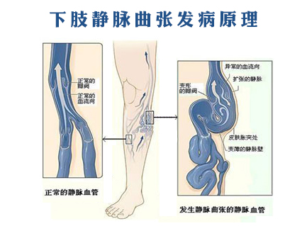 脚上的血管鼓起是怎么回事