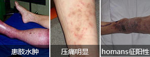 静脉血栓的危害有哪些