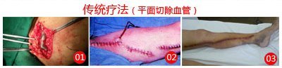 下肢静脉血栓的治疗方法