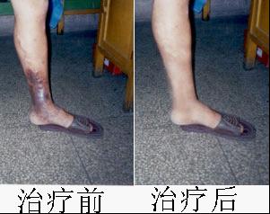 血栓性静脉炎怎么治疗