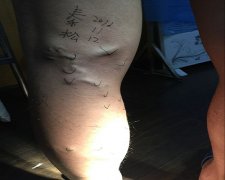 静脉曲张小腿酸胀怎么治疗？昆明哪里治疗好？