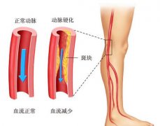 什么因素导致动脉硬化？如何治疗效果好