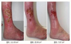 老烂腿抓紧时机早治早好，谨防癌变