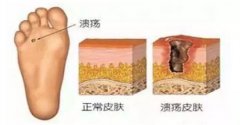 糖尿病足诱发的原因有哪些？