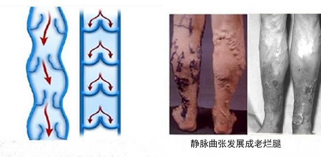 如何避免老烂腿恶化