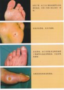 糖尿病足的认识和病因