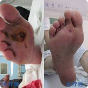 糖尿病足一定要截肢吗？昆明三一一医院