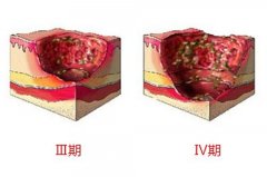 褥疮患者应该怎么护理？